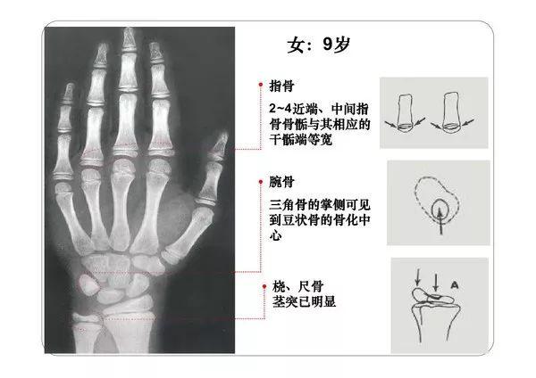 最新版女孩骨龄标准对照表